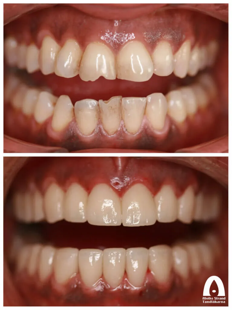 Före- och efterbild: Smile makeover, över- & underkäke (2)
