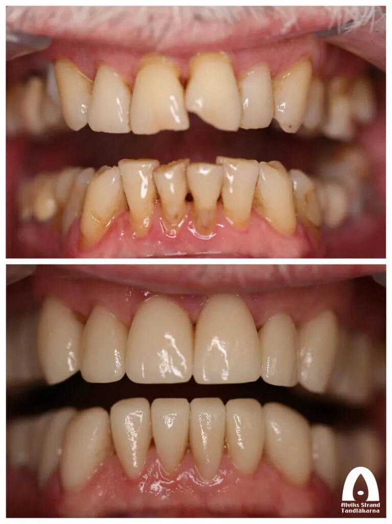 Före- och efterbild: Smile makeover
